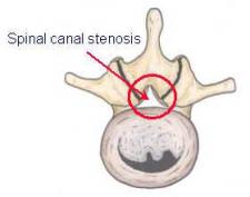 Spinal Canal Stenosis – Adelaide Spine & Brain